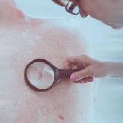 Magnifying glass over skin cancer.